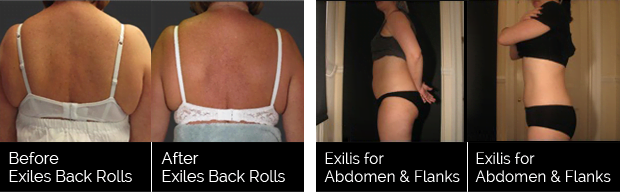 power-plus-exilis-elite-treatment