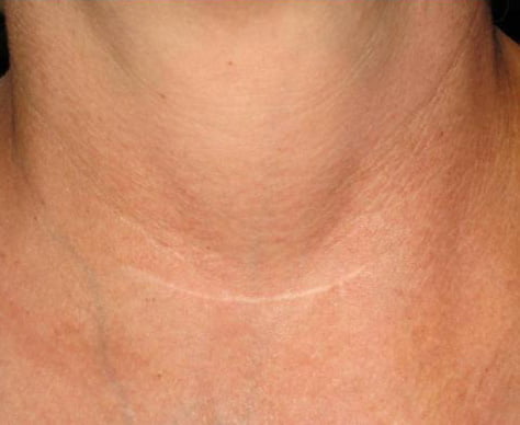 neck_scars_after