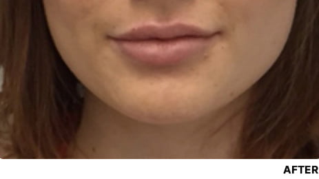 Lip Fillers cost