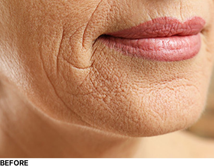 Face Scar Before DermaPen Treatment Image