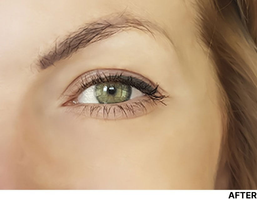 Under Eye wrinkles After DermaPen Treatment Image