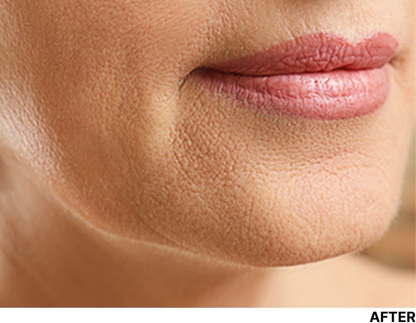 Face Scar After DermaPen Treatment Image