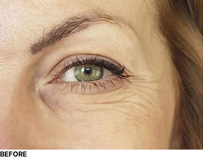 Under Eye wrinkles Before DermaPen Treatment Image