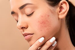 Acne Vulgaris before treatment small image
