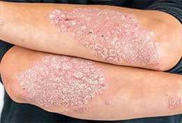 Autoimmune Connective before treatment Small image