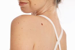 Skin Tags Before Treatment small image