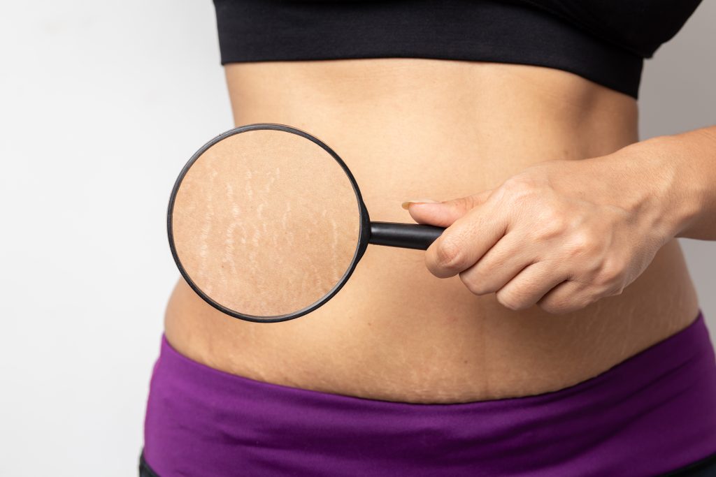 Younger, smoother looking skin after Fraxel laser