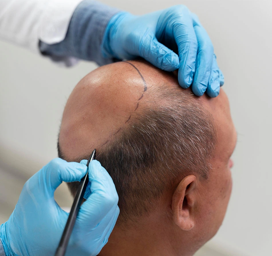 17 Best Hair Loss Treatments for Men in 2023