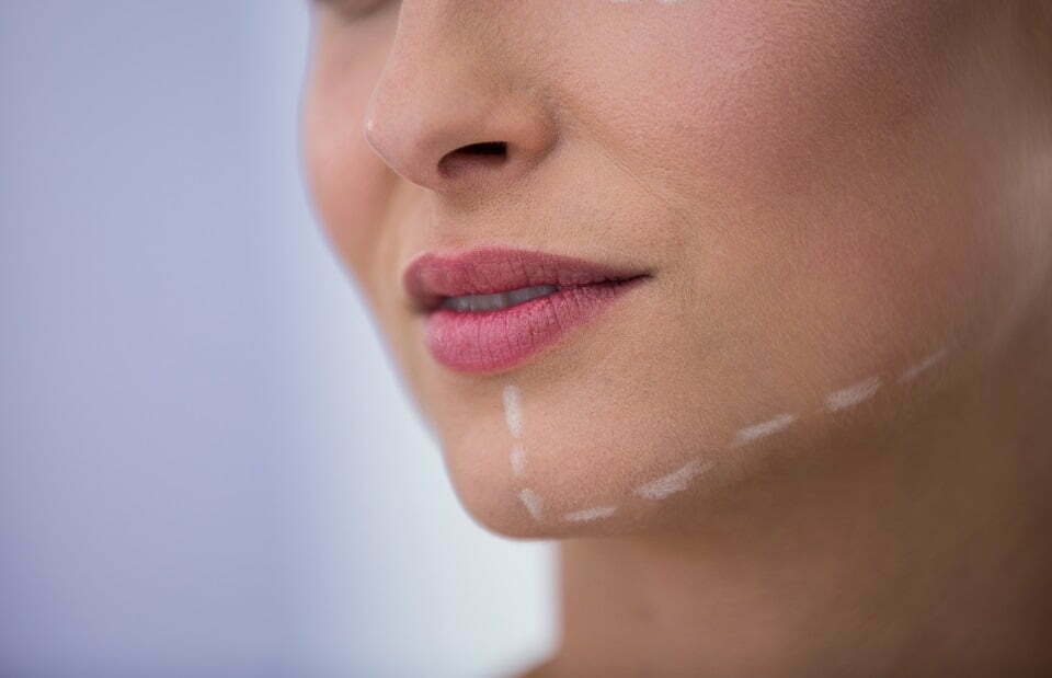 Reduce double chin non-surgically
