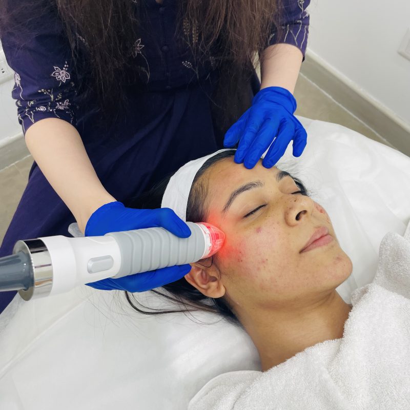 AAYNA Renew Laser Treatment for Acne Scars