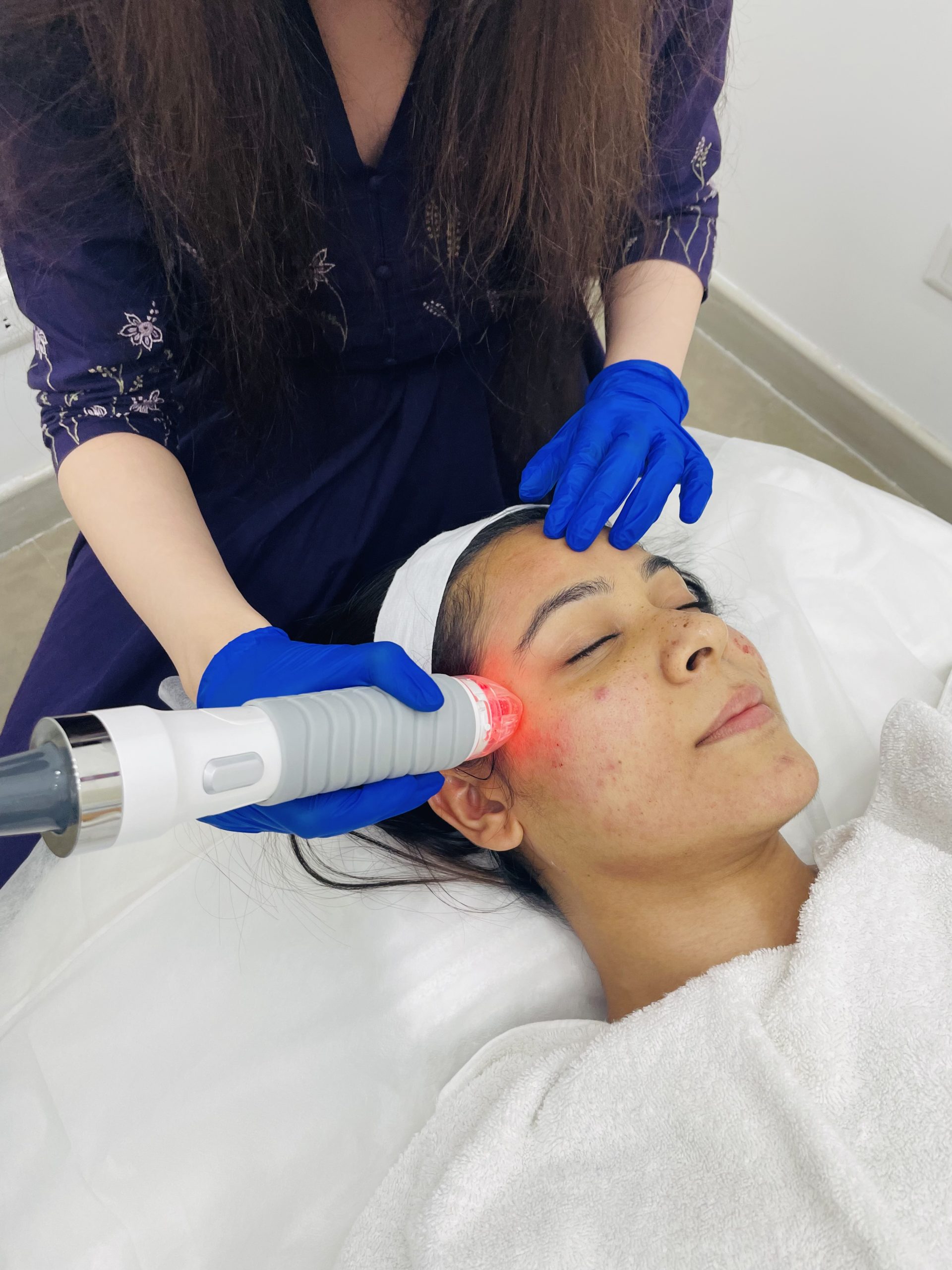 Is Laser Treatment for Acne Scars the Best Answer for You?