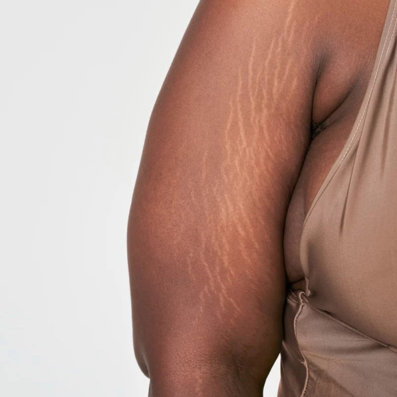 Fraxel laser: treatment for Stretch Marks on Arms