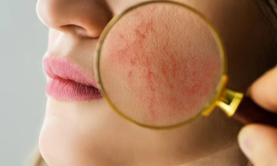 Your Flushed Face May Turn into Rosacea