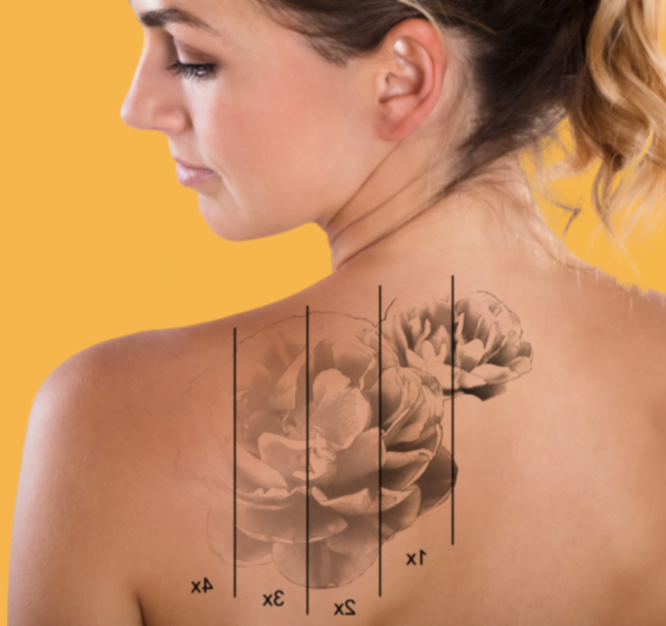 Tatto Removal in delhi