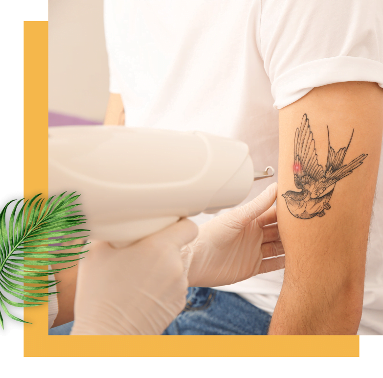 Laser Tattoo Removal  Geelong Veins Skin and Laser
