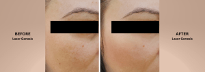 pore reduction treatment with Photofacial