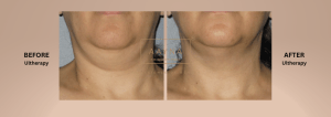 Real results by Ultherapy at AAYNA. Visible reduction in double chin and skin tightening