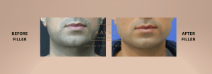 Dermal fillers for men - lip filler before and after