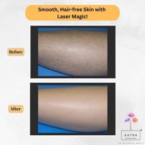 Laser Hair Reduction at AAYNA Before and After