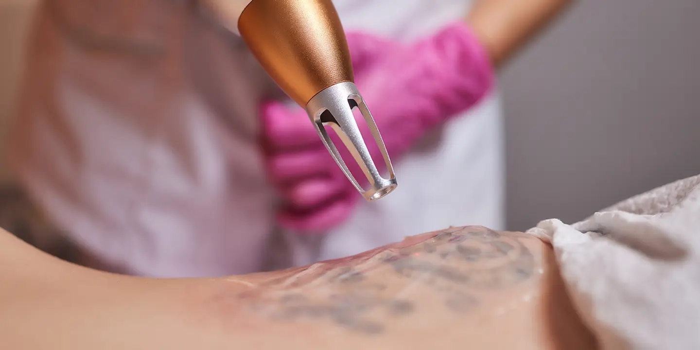 14 Things No One Tells You About Tattoo Removal
