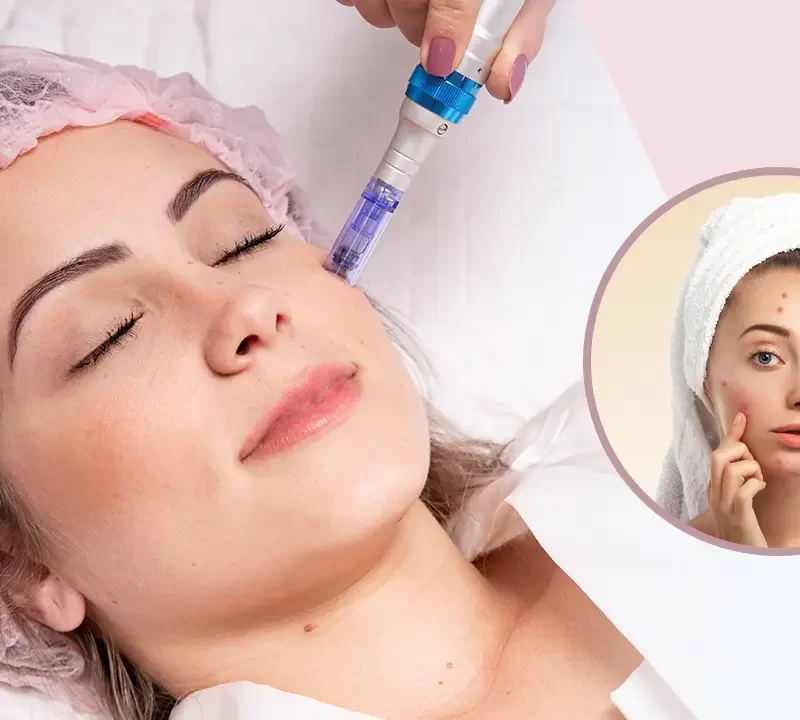 Dermapen Microneedling Treatment for Acne
