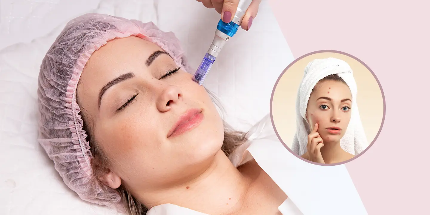 Dermapen Microneedling Treatment for Acne