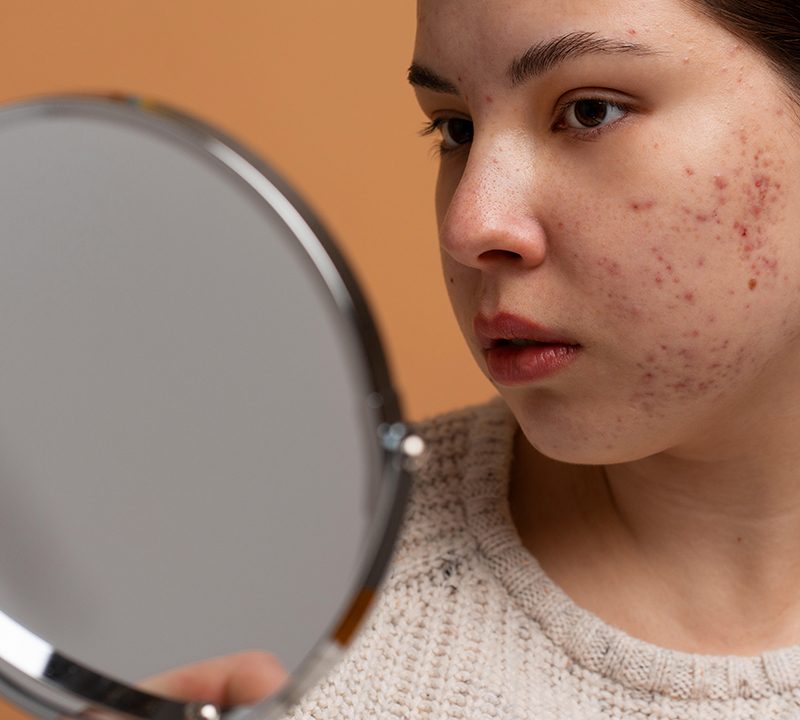 Dark Spots on Skin / Dark Spots on Face Treatment