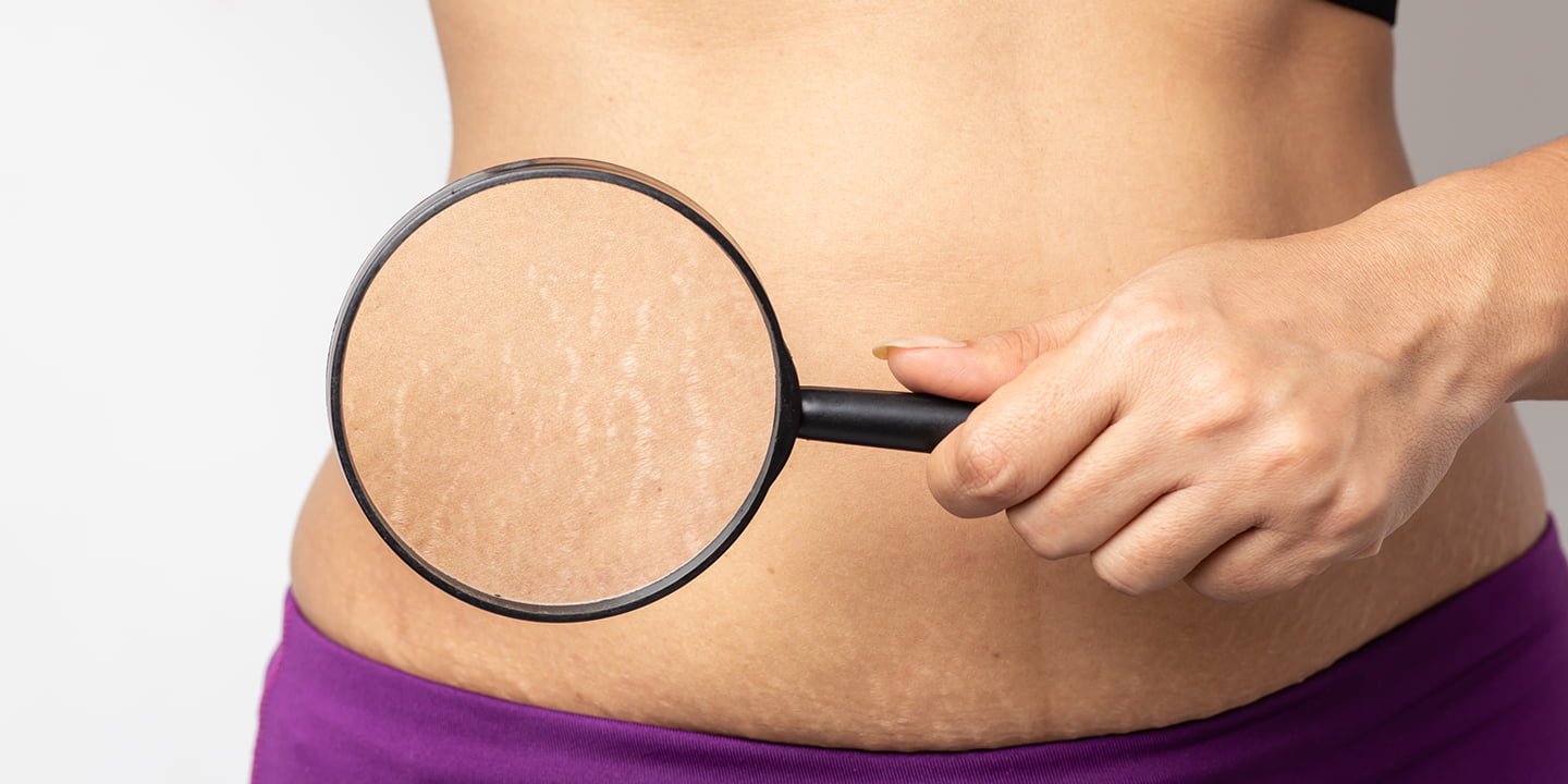 Lifestyle Changes to Minimize and Prevent Stretch Marks