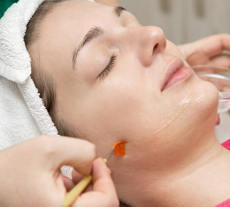 Chemical Peel
