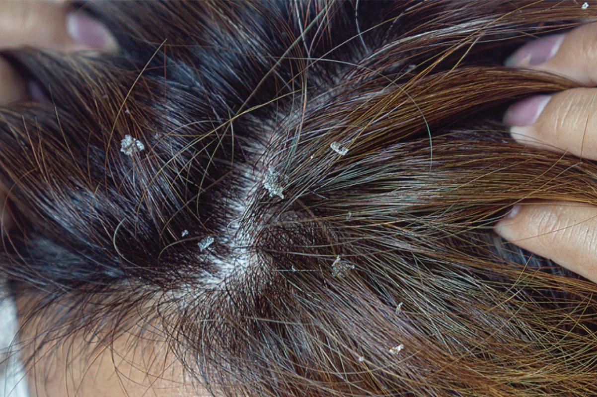 What causes dry scalp hotsell