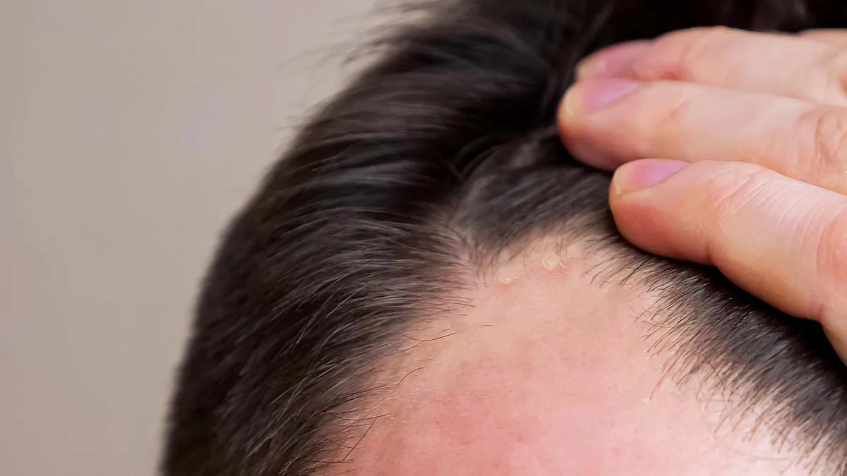 The Secret Behind Scalp Acne: Tips for Clear & Healthy Scalp