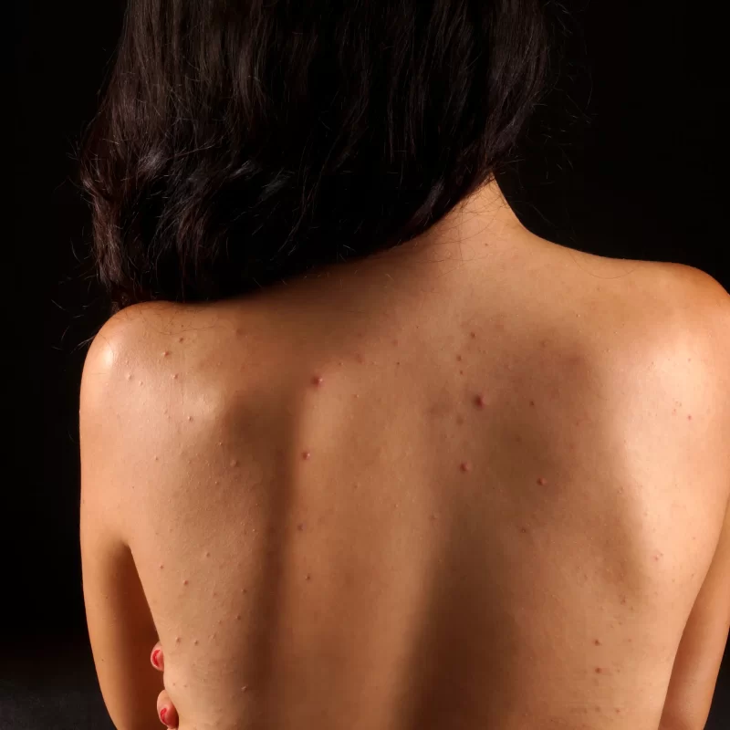 bacne, back acne, acne