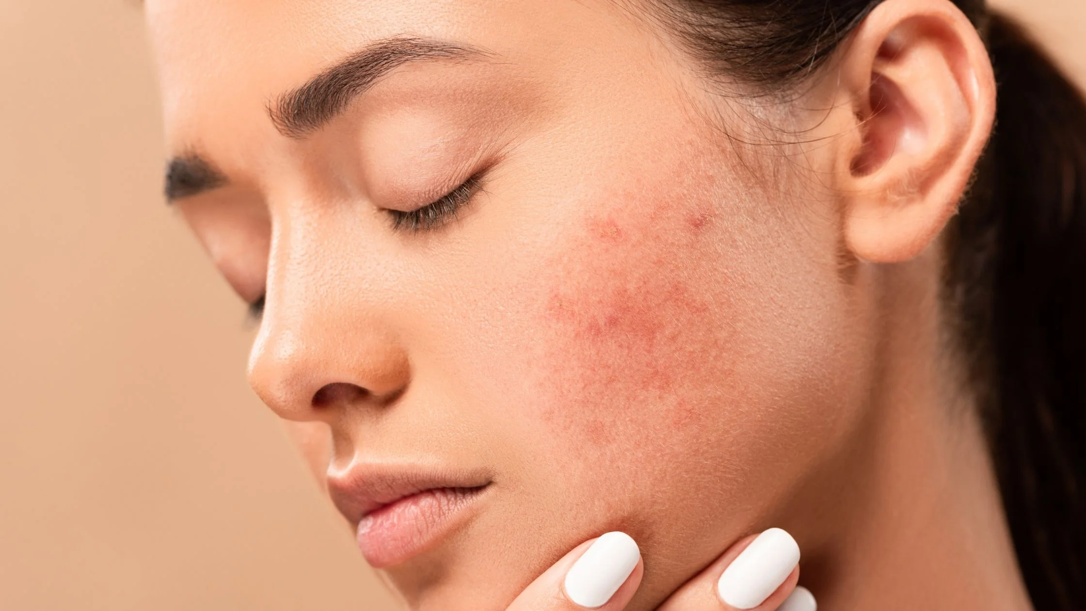 8 Ways to Treat Hormonal Acne: According to Derms