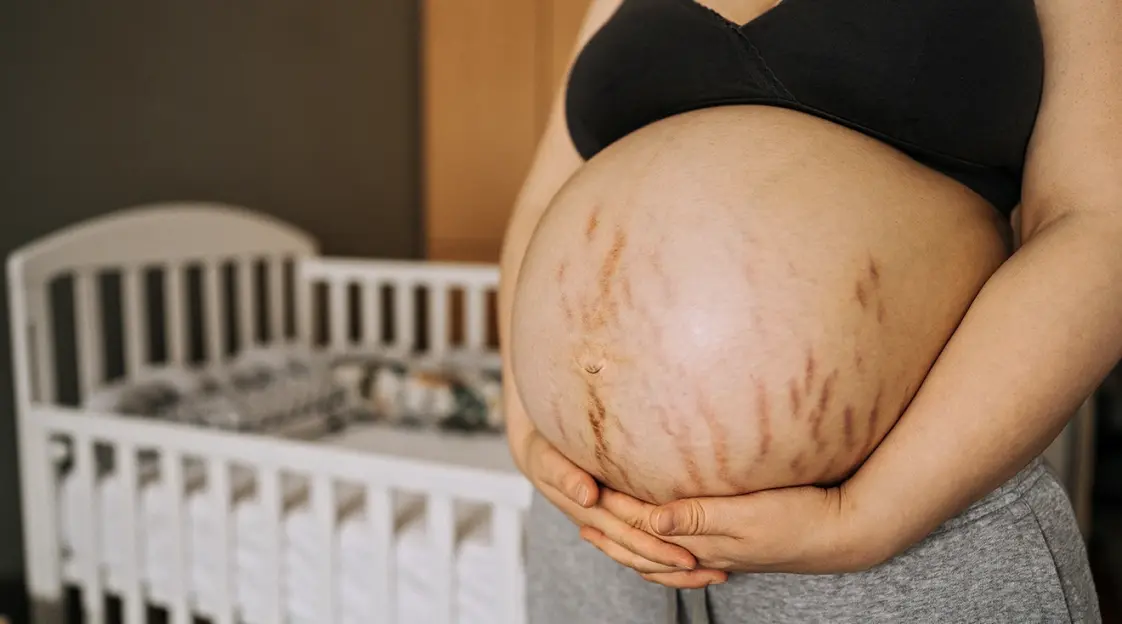 Expert Advice: Keeping Stretch Marks at Bay During Pregnancy