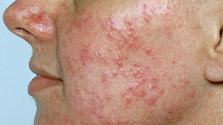 Rosacea