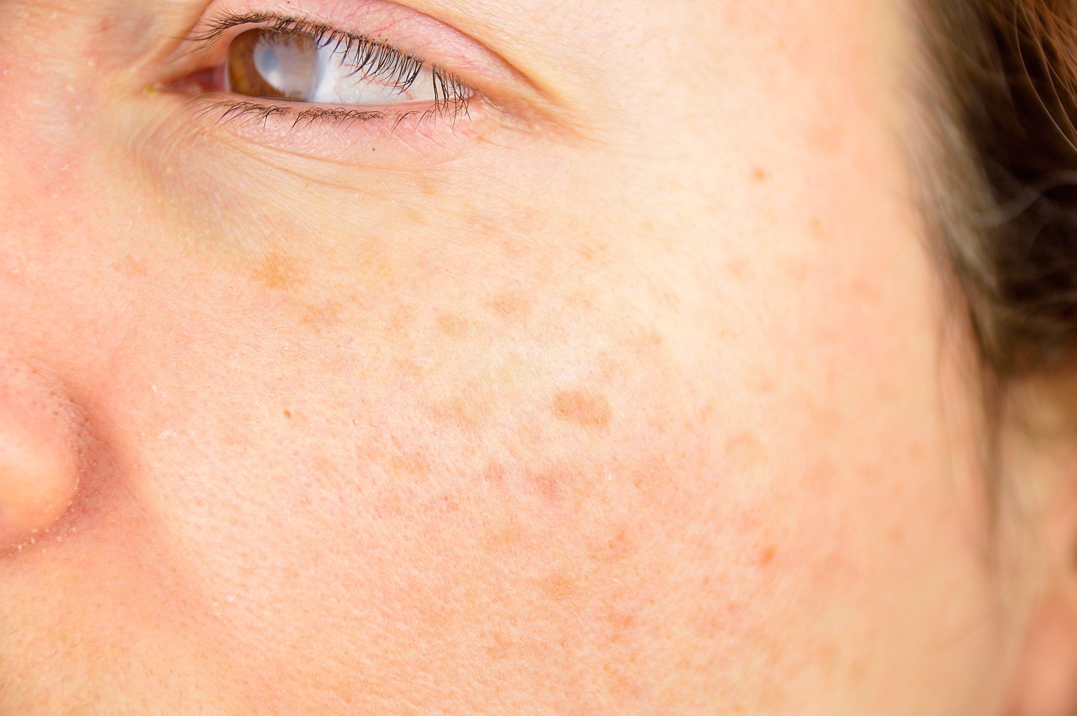 Top 7 Home Remedies, Causes, and Treatments for Sunspots