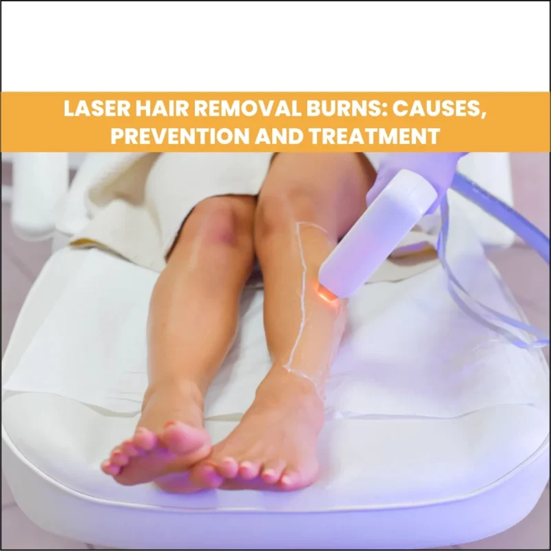 Laser Hair Removal Burns