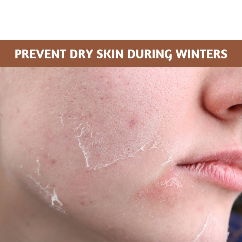 Dry Skin During Winters