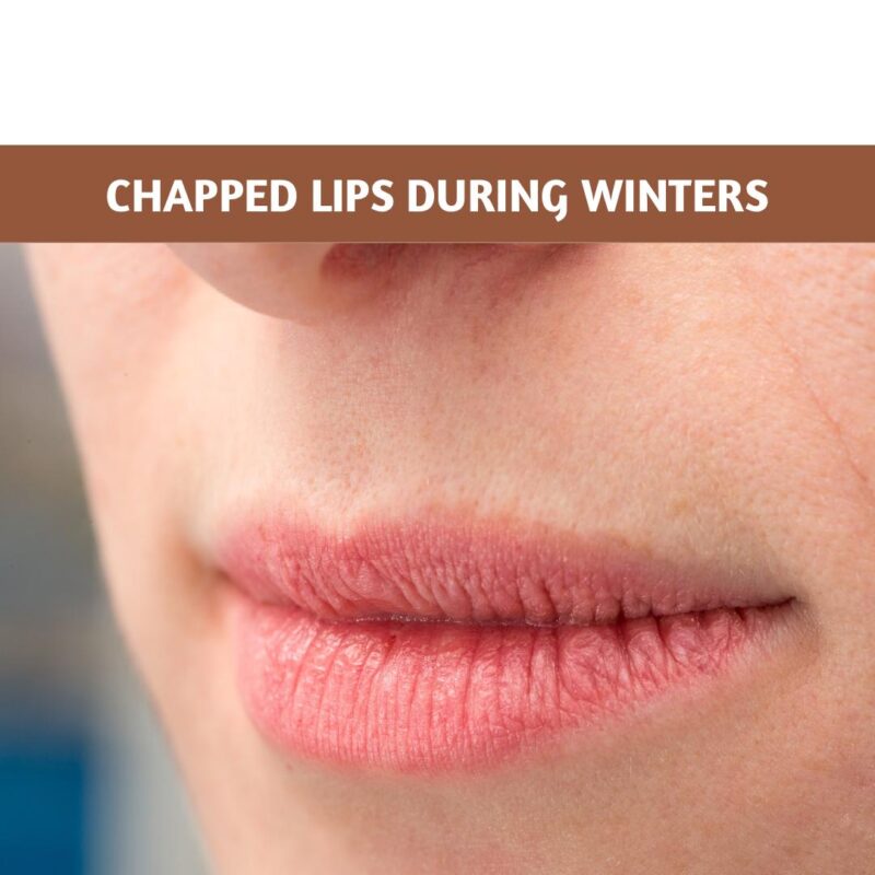Chapped Lips During Winters