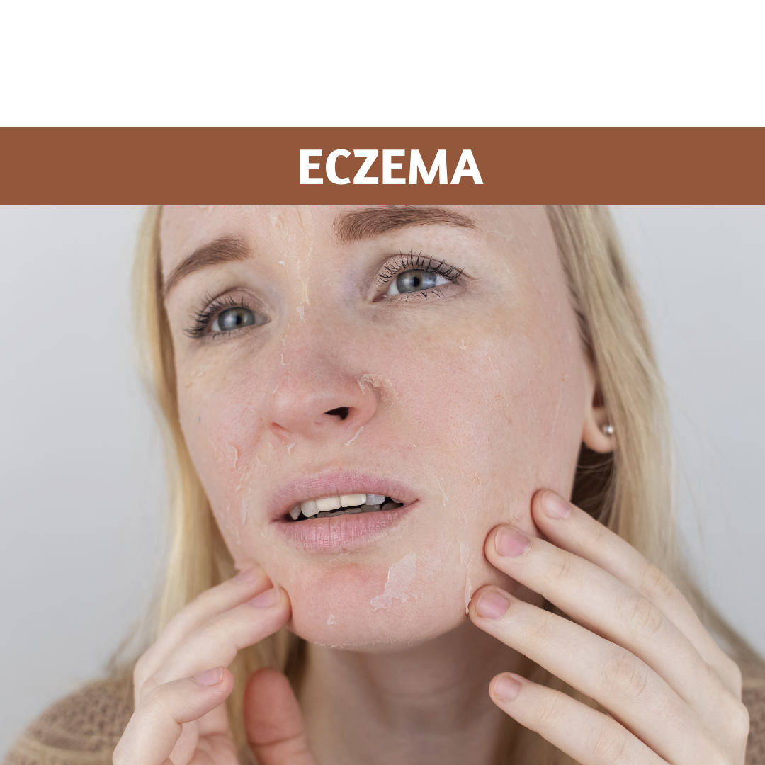 Managing Eczema During Winter: A Comprehensive Guide