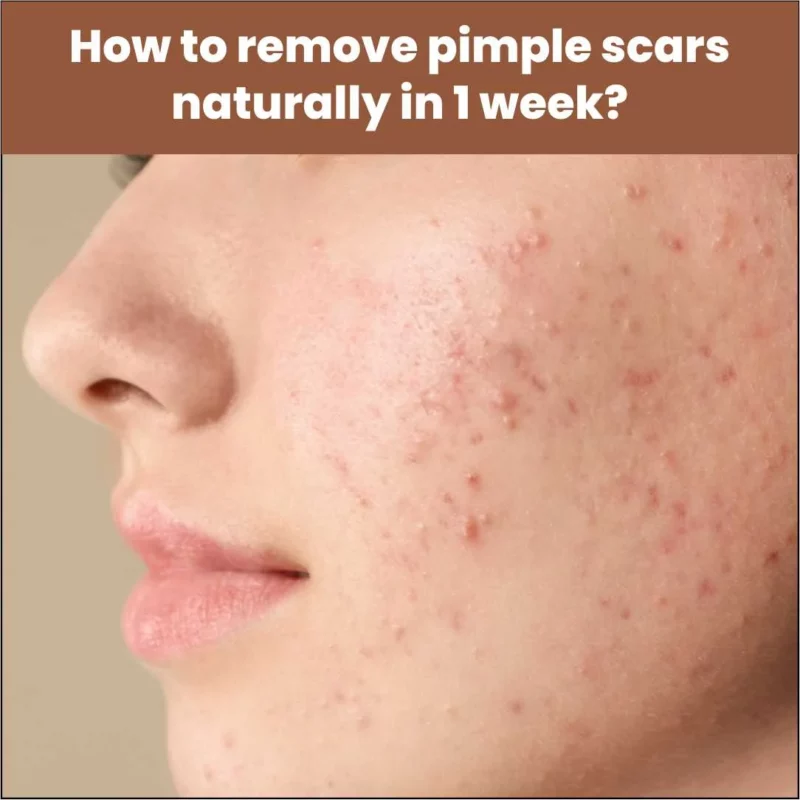 How to Remove Pimple Scars Naturally in 1 Week?