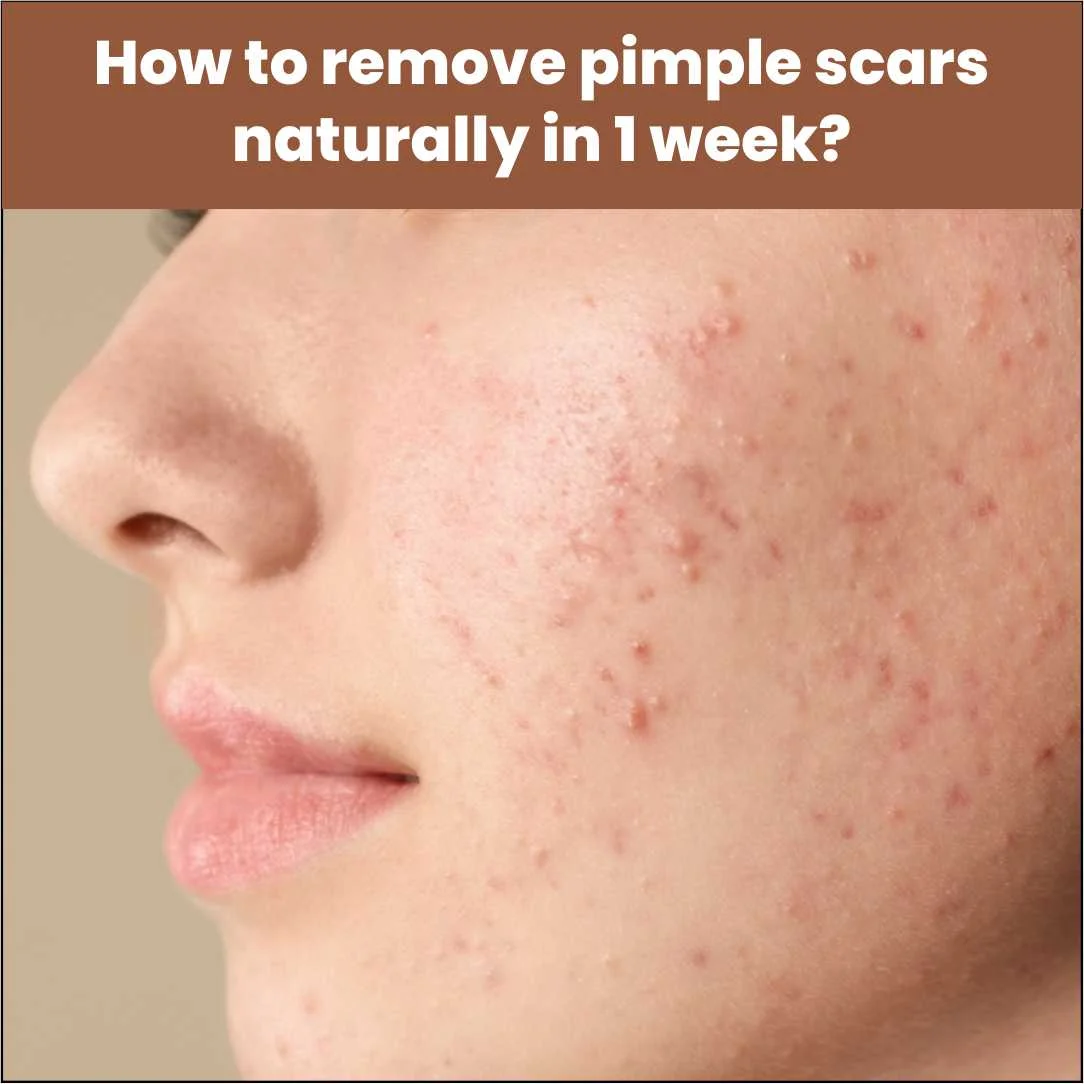 How to Remove Pimple Scars Naturally in 1 Week?