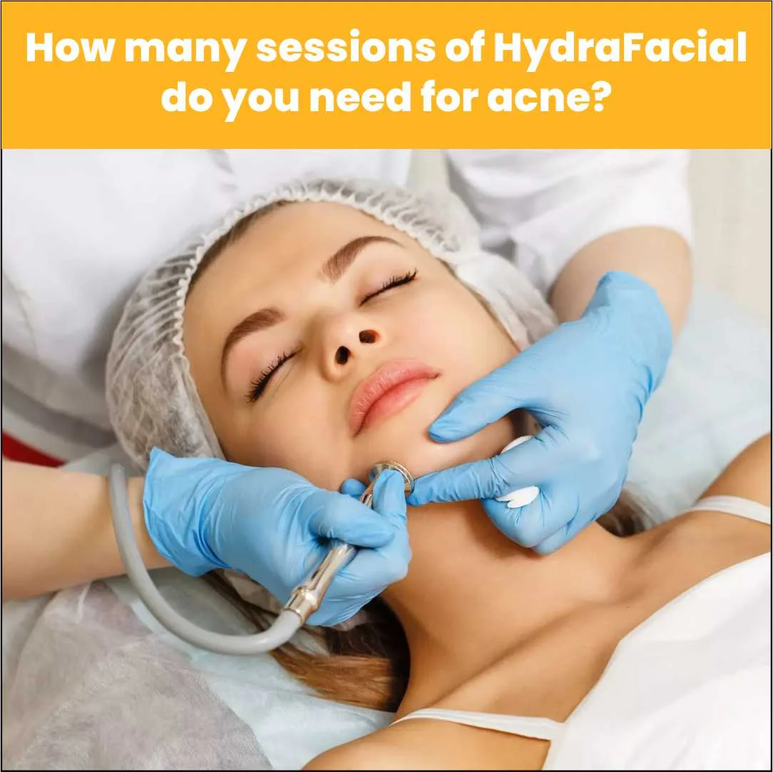 How Many Sessions Of Hydrafacial Do You Need For Acne?
