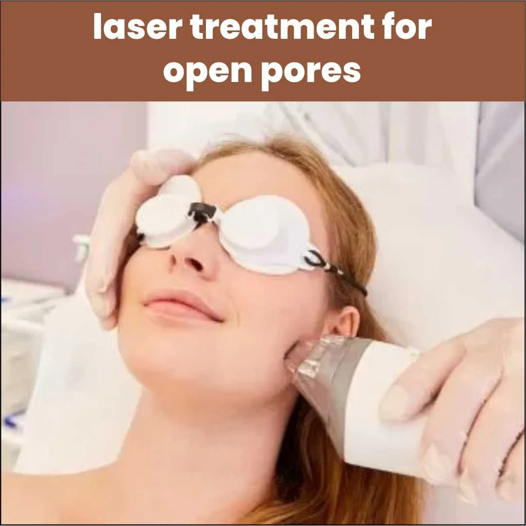 Laser Treatment for Open Pores: The Modern Solution to Smooth, Flawless Skin
