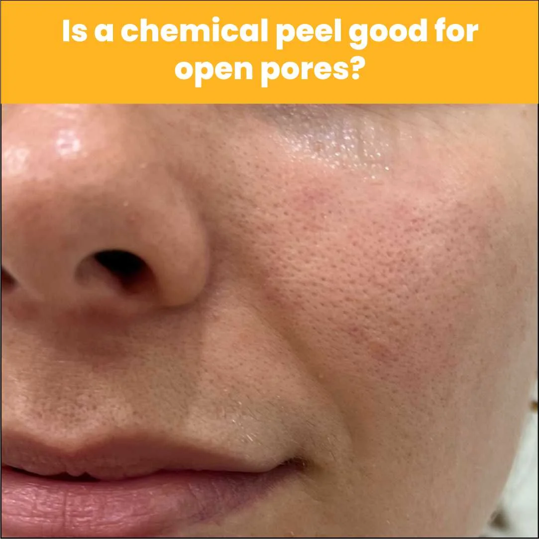 Is A Chemical Peel Good For Open Pores?
