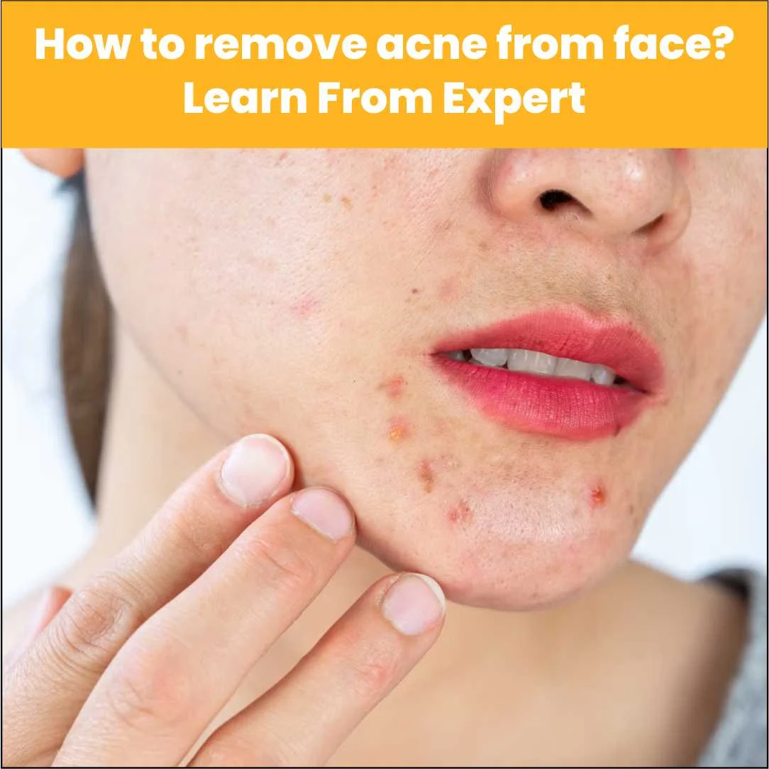 How to Remove Acne from Face? Learn from Experts at AAYNA Clinic