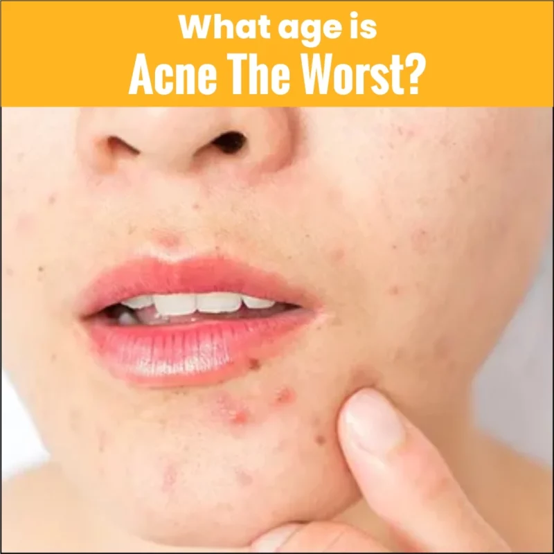 At What Age Is Acne the Worst?