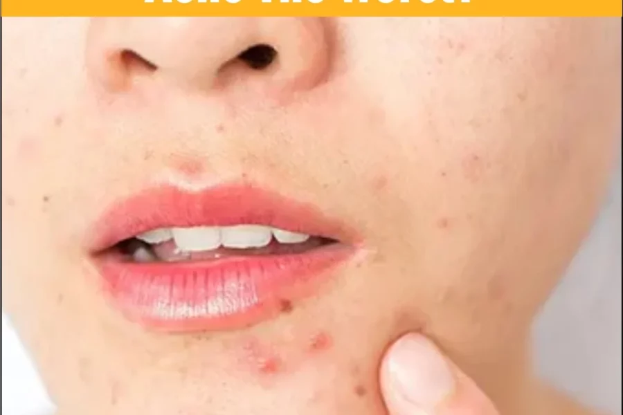 At What Age Is Acne the Worst?
