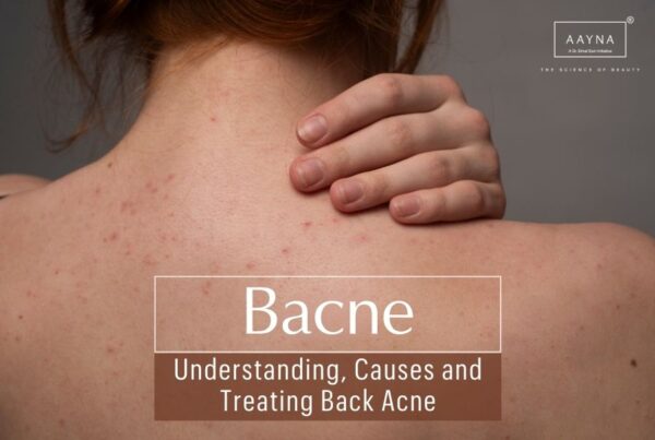 Bacne, Back Acne