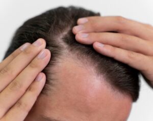 4 Non-Surgical Hair Replacement in Delhi: Which Treatment Actually Works?